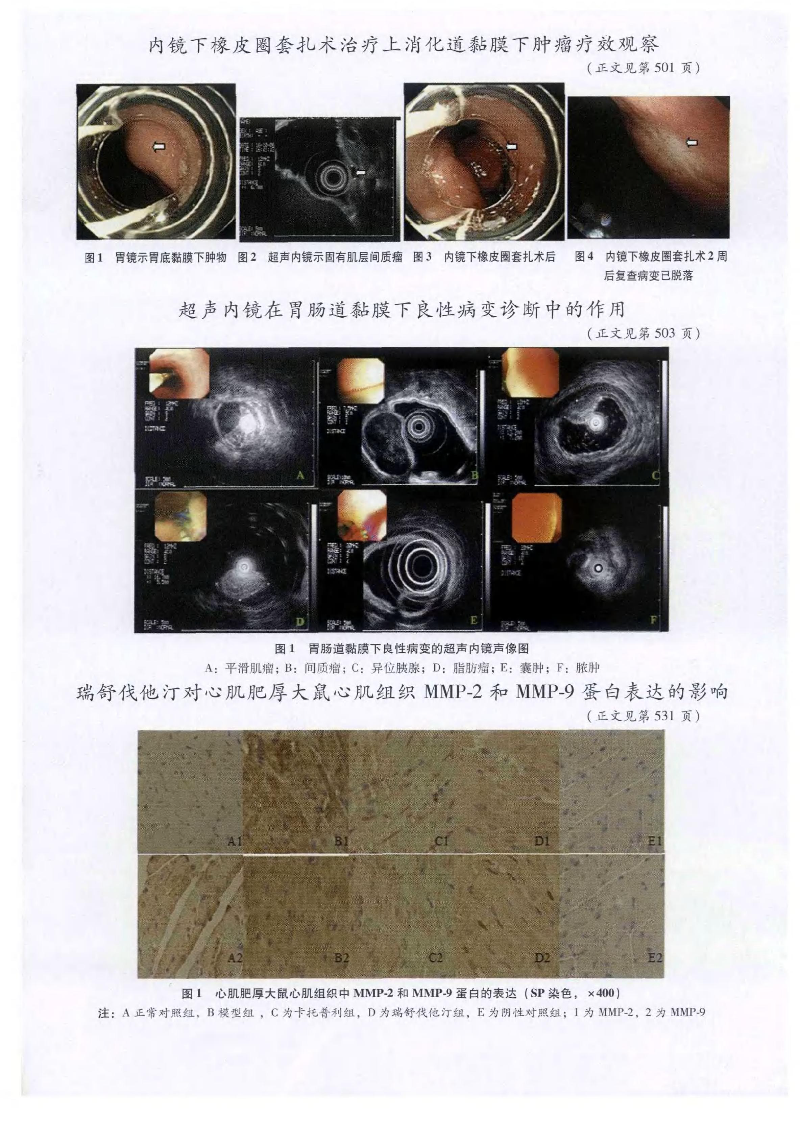 內(nèi)鏡下橡皮圈套扎術(shù)治療上消化道黏膜下腫瘤療效觀察──附46例報(bào)告-圖片-3.jpg